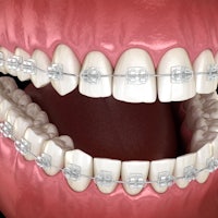 a close up of a tooth with braces on it