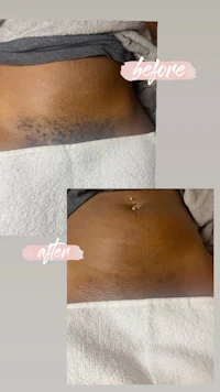 a woman's stomach before and after laser hair removal