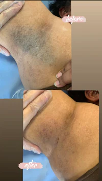 before and after pictures of a woman's back