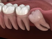 a close up of a tooth with a crown on it
