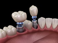 a tooth with a dental implant in it