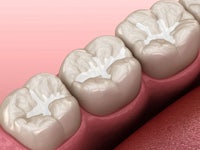 a close up of a tooth with white fillings