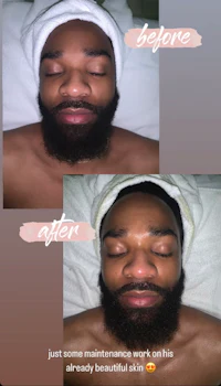 a man with a beard before and after his treatment