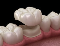 an image of a tooth with a crown on it