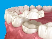 a 3d model of a dental implant