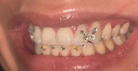 a close up of a woman's teeth with dental veneers