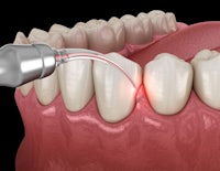 an image of a tooth being treated with a laser