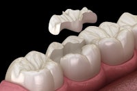 a 3d model of a dental implant