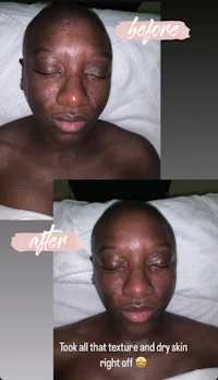 a picture of a woman's skin before and after treatment