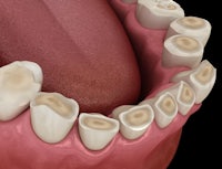 a 3d model of a tooth with teeth missing