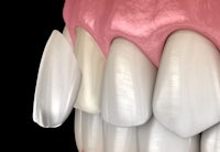 a 3d image of a tooth with white fillings