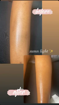 a woman's leg before and after a sun light treatment