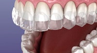 a close up of a tooth with clear veneers
