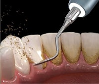 a dentist is using a tool to clean a tooth