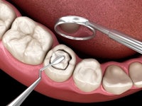 an image of a tooth with a tool in it