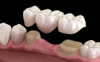a 3d rendering of a dental implant